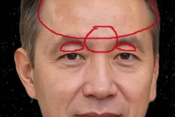 如何通过额头疤痕判断未来运势